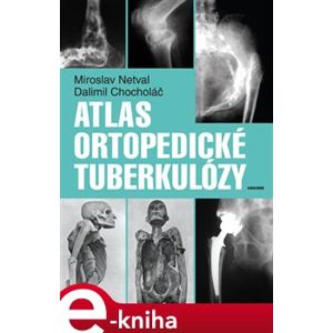 Atlas ortopedické tuberkulózy - Miroslav Netval, Dalimil Chocholáč e-kniha